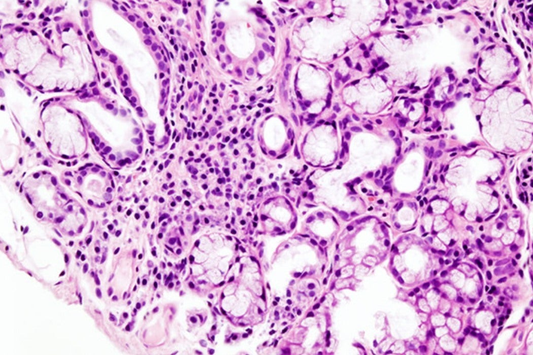 Sjögren syndrome