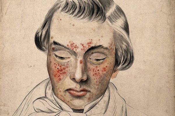 Illustration: Head of a man with a severe disease affecting his face by Christopher D' Alton, 1858

Source: https://www-jstor-org.bibliotheek.ehb.be/stable/community.24834473