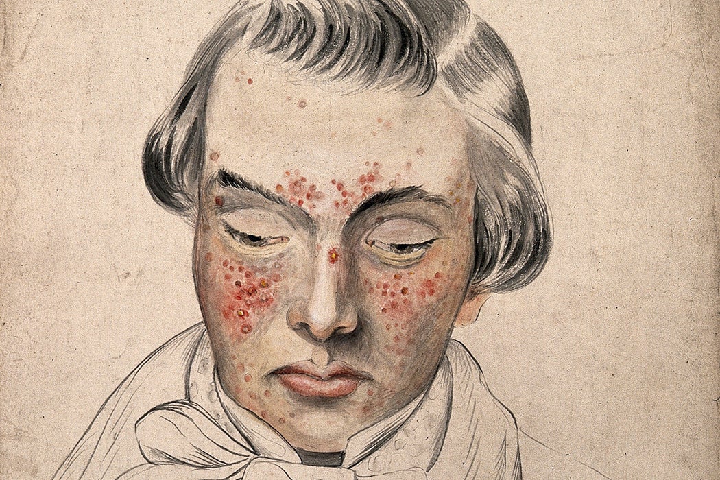 Illustration: Head of a man with a severe disease affecting his face by Christopher D' Alton, 1858

Source: https://www-jstor-org.bibliotheek.ehb.be/stable/community.24834473